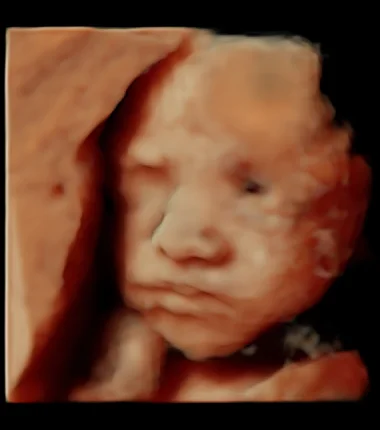 Imagen de ultrasonido fetal 4D durante un estudio anatómico